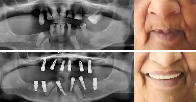 Clinical Case: Full Mouth Dental Impants with All on 6