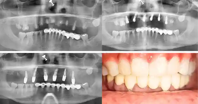 Clinical Case: Half Arch Bridge with Dental Implants